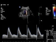Doppler A uterina SSW 12