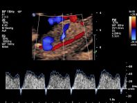 Ductus venosus mit reverse flow