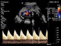 Doppler Nabelarterie UmA