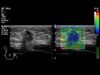 Brustkrebs mit Strain Elastographie Itoh 4