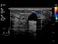 Harmlose Cyste mit Farbdoppler